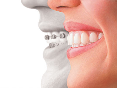 Modern Dental Care of Queens | Dental Sealants, Inlays  amp  Onlays and Periodontal Treatment