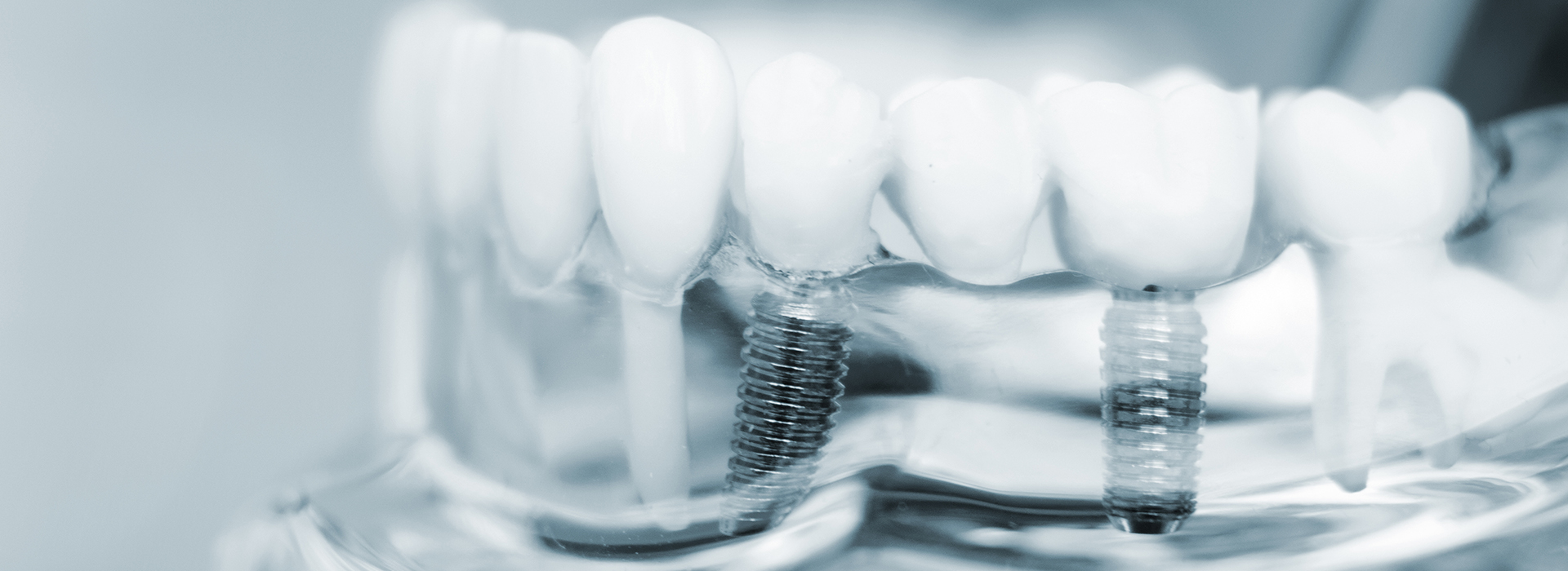 Modern Dental Care of Queens | Dental Sealants, Root Canals and Veneers