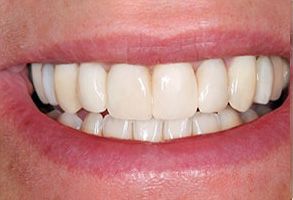Modern Dental Care of Queens | ZOOM  Whitening, Dentures and Pediatric Dentistry